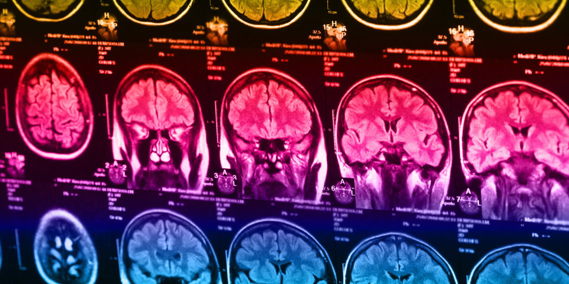 Usuários excessivos de smartphones demonstram maior reatividade cerebral à exclusão social