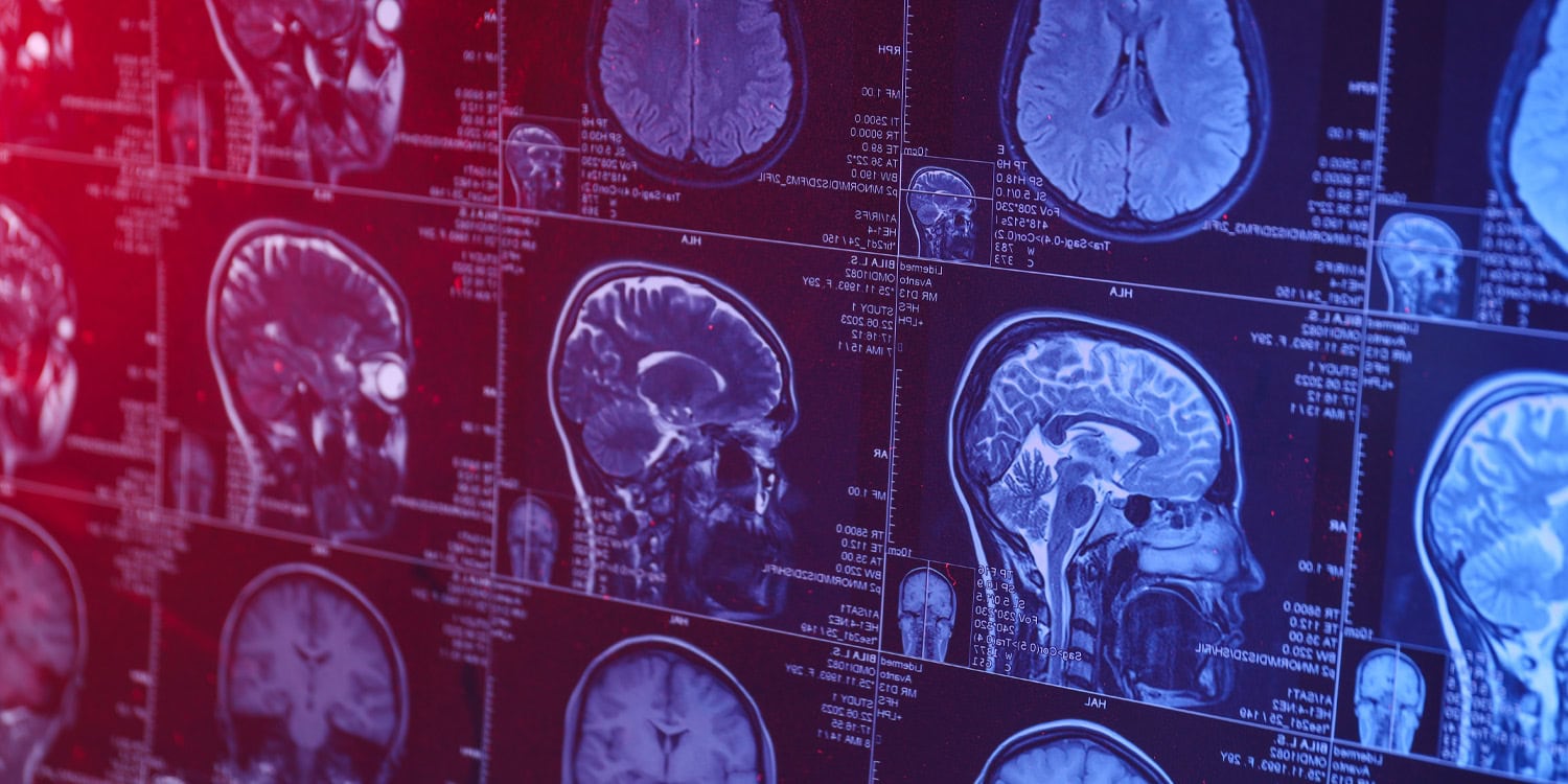 Morre aos 24 anos vítima de demência – como o último gesto de generosidade de um jovem pode mudar para sempre a pesquisa cerebral