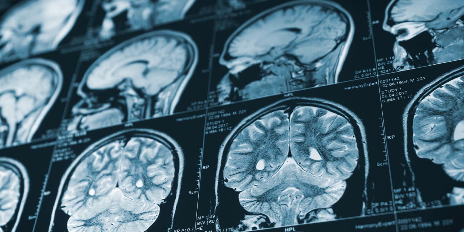 Traumas na infância estão ligados a diferentes padrões de envelhecimento no cérebro na meia-idade
