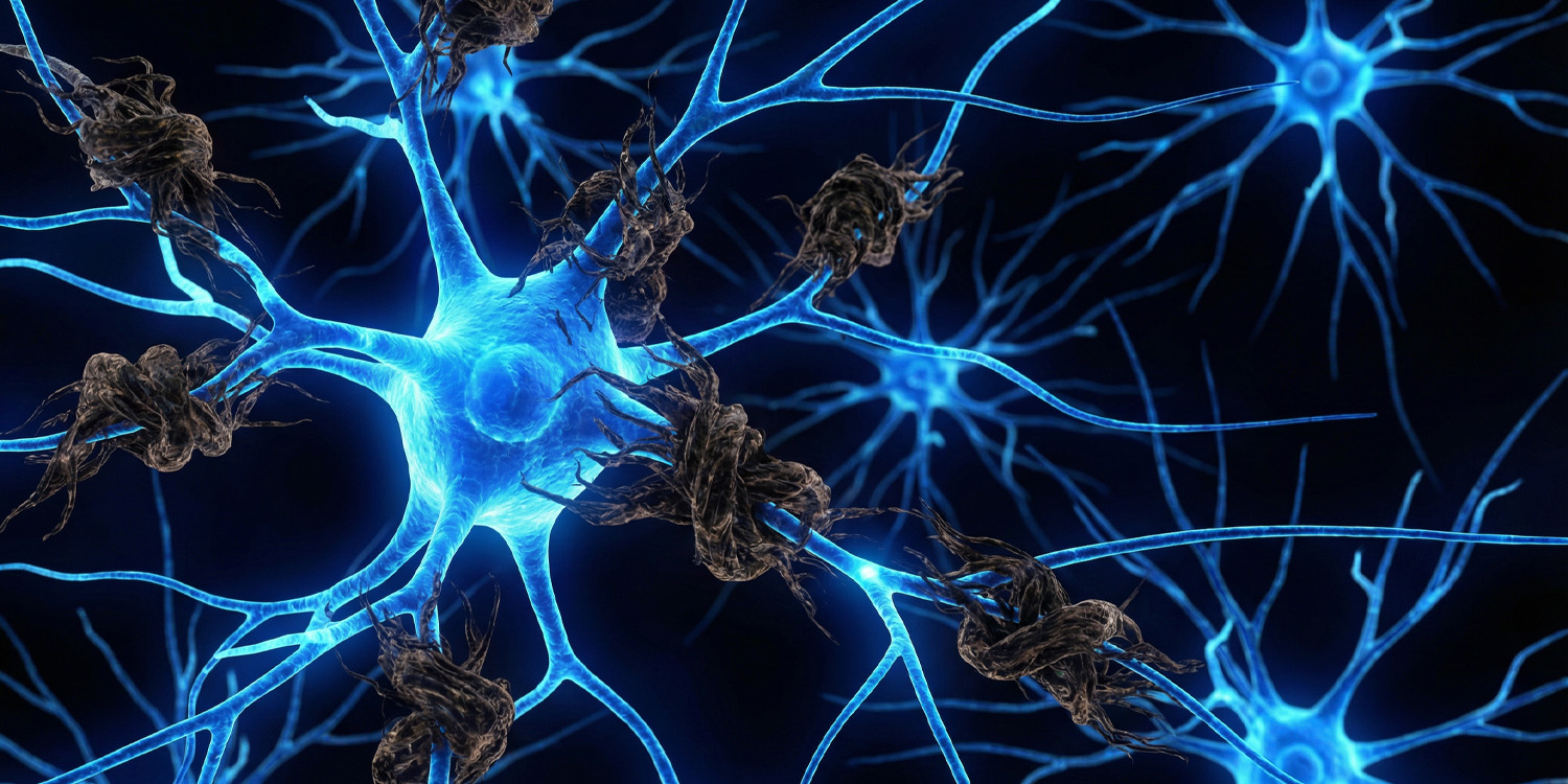 Targeting toxic protein chains could slow neurodegenerative disease